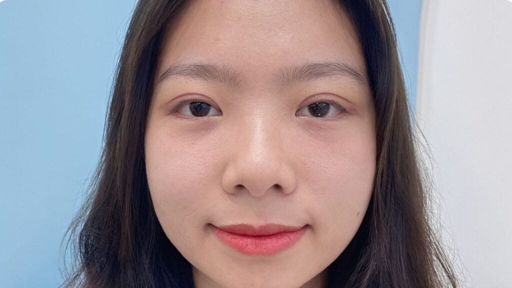 Cắt mí bao lâu thì đẹp? Các mốc 7 ngày, 2 tuần, 1 tháng thay đổi rõ rệt