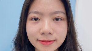 Cắt mí bao lâu thì đẹp? Các mốc 7 ngày, 2 tuần, 1 tháng thay đổi rõ rệt