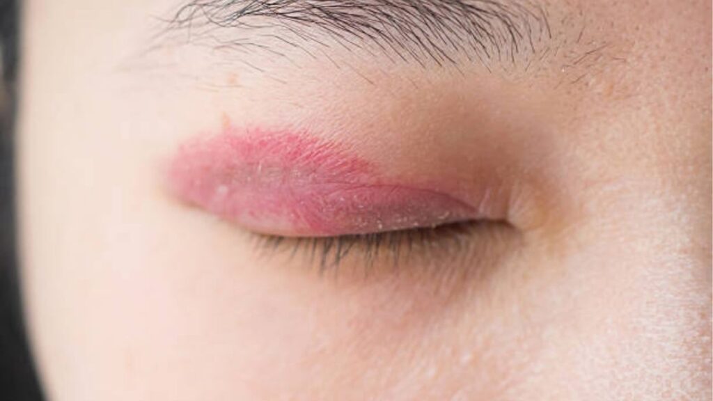 Cắt mí bị bầm có sao không? Bao lâu thì hết và cách tan bầm nhanh