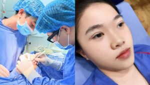 Cắt mí bị bầm có sao không? Bao lâu thì hết và cách tan bầm nhanh