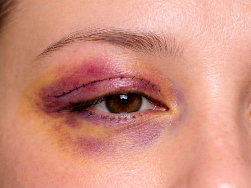 Hình ảnh mí mắt bị bầm sau khi cắt mí