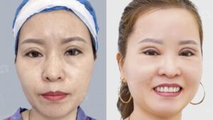 Cắt mí bị lệch: Cách phân biệt sưng nề tạm thời và Biến chứng cần sửa 2026