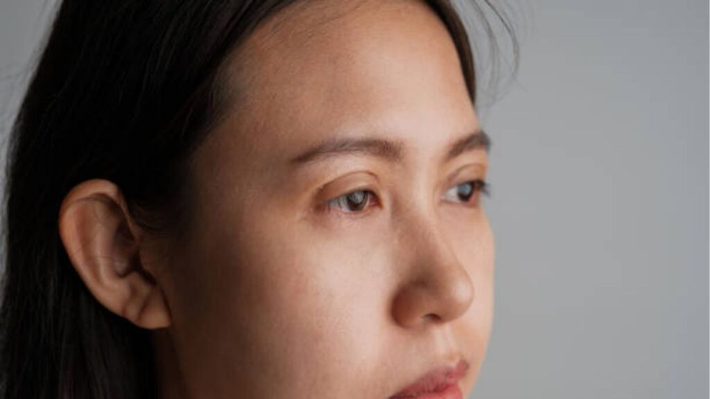 Cắt mí bị trợn: Giải pháp sửa mí hỏng & Quy trình tái cấu trúc an toàn 2026