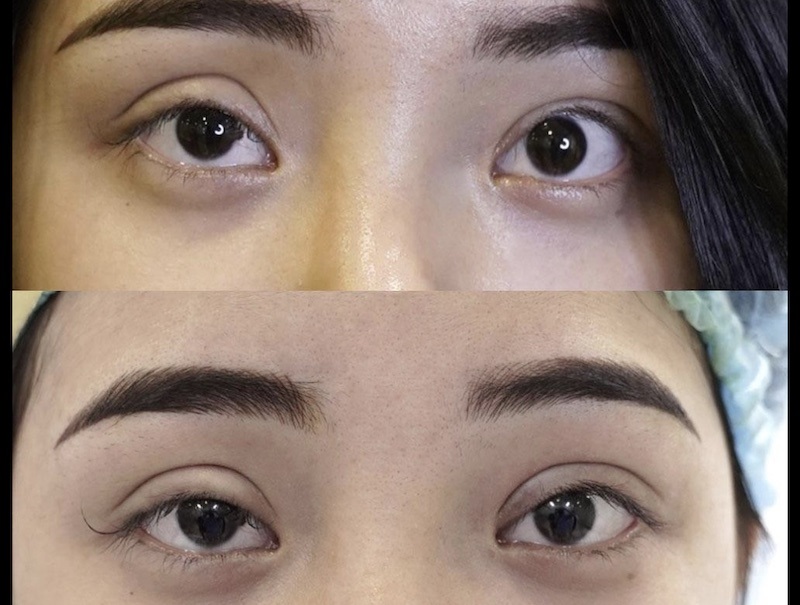 Mí bị trợn do cắt mí bị hỏng, bác sĩ loại bỏ nhiều da