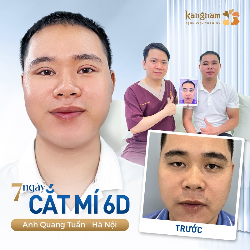 Cắt mí 6D giúp tạo nếp mí cân đối, nam tính cho nam giới