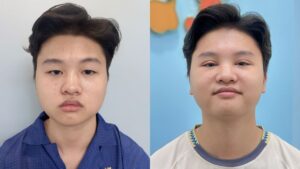 Cắt mí cho nam: Quy chuẩn tỷ lệ vàng để đôi mắt sâu, nam tính 2026