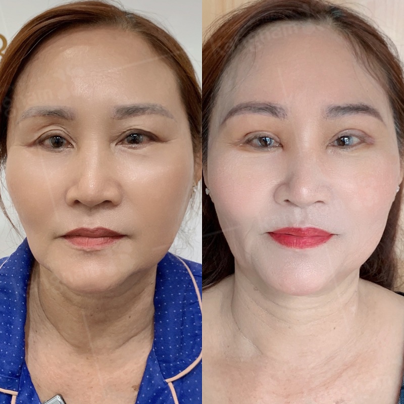 Da dư che khuất tầm nhìn của người lớn tuổi