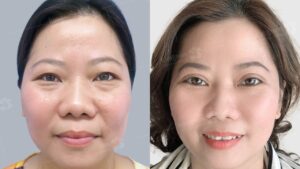 U50 – U60 có nên cắt mí không? 5 điều kiện an toàn và lời khuyên từ bác sĩ