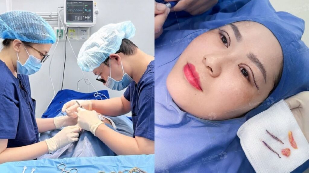 Cắt mí có ảnh hưởng gì không? Có ảnh hưởng thị lực, thần kinh về sau không?