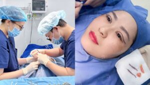 Cắt mí có ảnh hưởng gì không? Có ảnh hưởng thị lực, thần kinh về sau không?