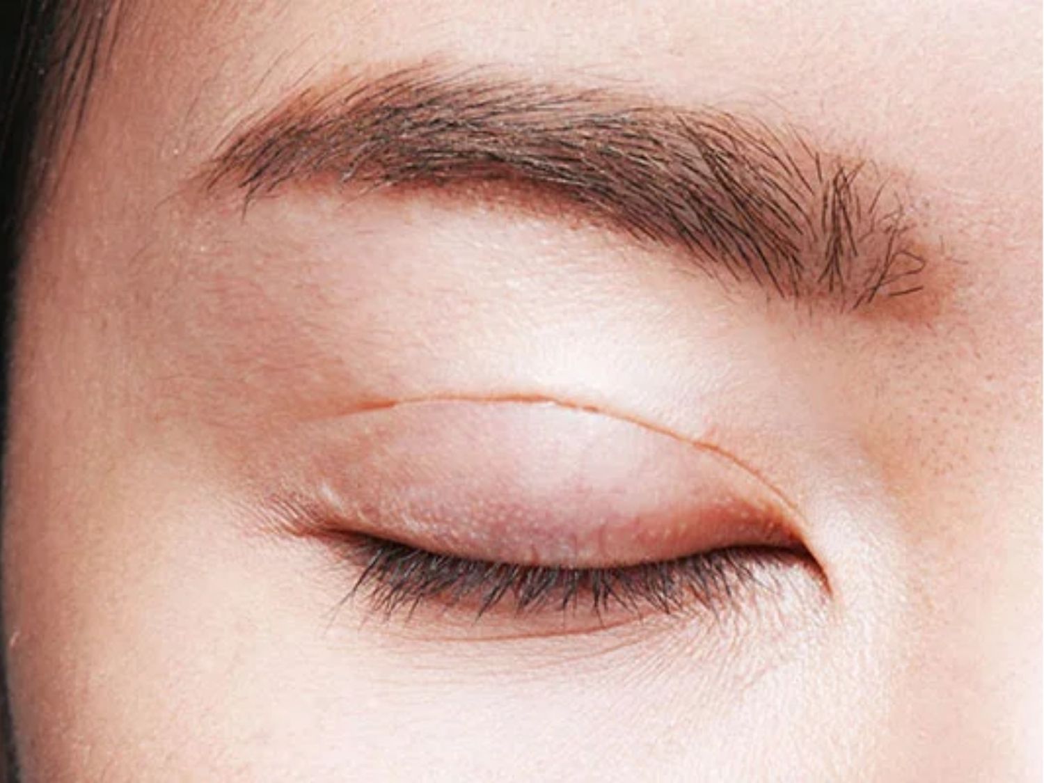 Kỹ thuật không chuẩn khiến mí mắt lộ sẹo sau cắt mí, ảnh hưởng đến thẩm mỹ và tâm lý