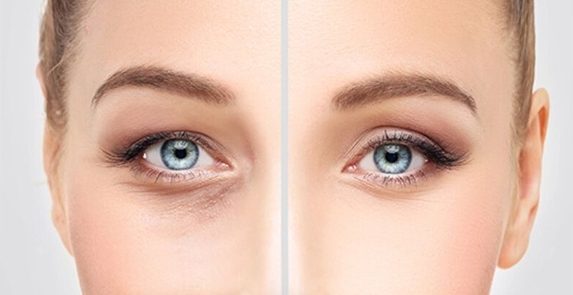 Bắt buộc phải lấy mỡ mí mắt nếu mắt nhìn sưng, thiếu sức sống và trông già hơn tuổi