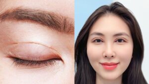 Cắt mí có cắt da không? Trường hợp nào cần và trường hợp nào không?