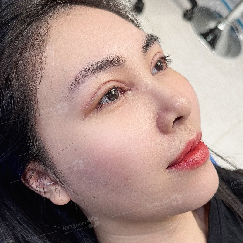 Đường sẹo mảnh như sợi chỉ, tiệp hoàn toàn vào màu da tự nhiên khi nhắm mắt.