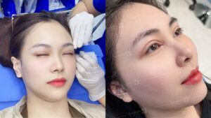 Cắt mí có để lại sẹo không? Bí quyết giấu sẹo tàng hình chuẩn Y khoa 2026