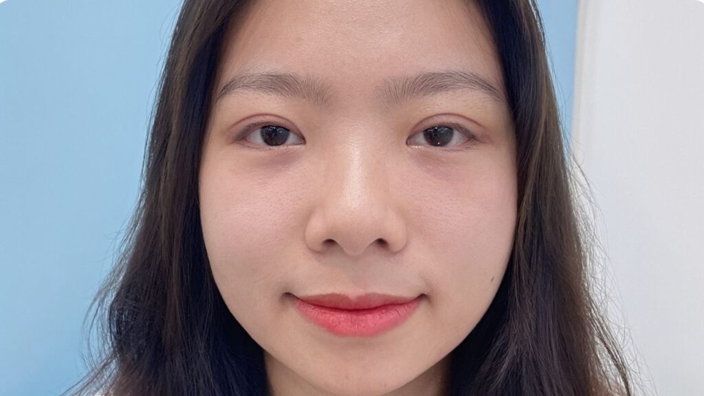 Cắt mí có phù hợp không? 7 dấu hiệu vàng và tư vấn từ chuyên gia thẩm mỹ