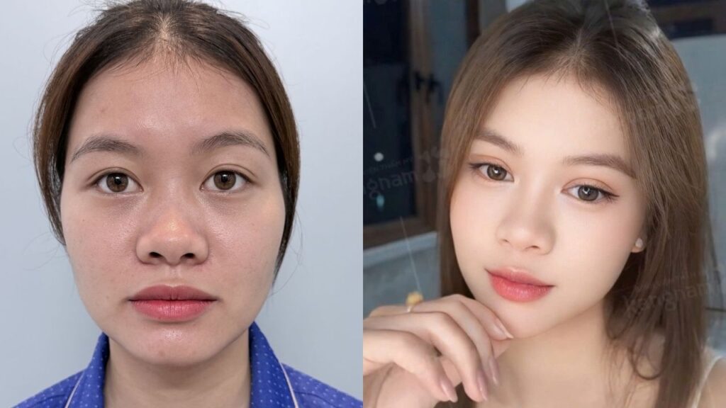 7 ngày thay đổi nếp mí của Diệu Yến tại Kangnam Hà Nội