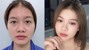 7 ngày thay đổi nếp mí của Diệu Yến tại Kangnam Hà Nội