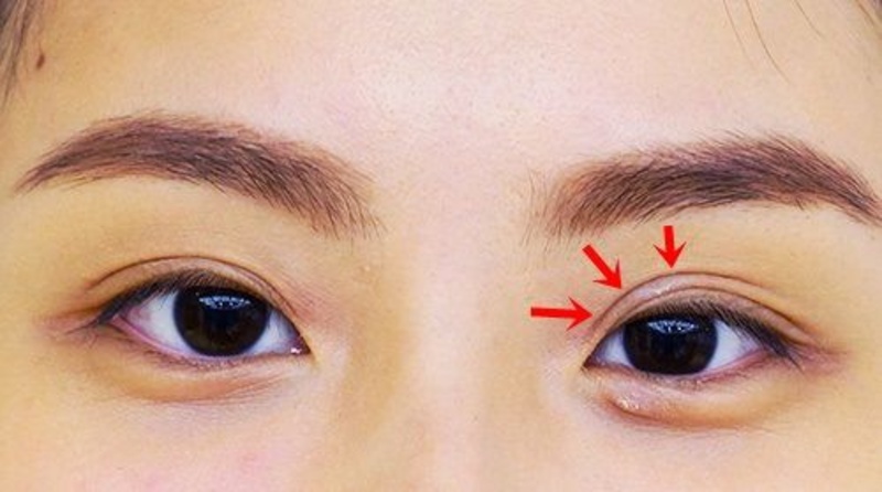 Cắt mí sẽ bị tụt và lão hóa theo thời gian, đăc biệt khi về già