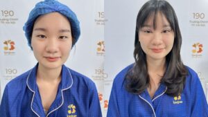 Hành trình “lột xác” đôi mắt 1 mí của Thu Hà tại Kangnam Hà Nội
