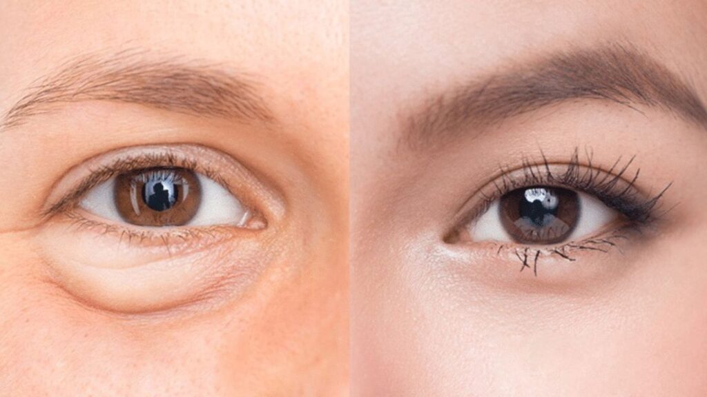 Mắt nhiều mỡ thì nên ưu tiên cắt mí để loại bỏ triệt để các túi mỡ sâu, giúp nếp mí rõ hơn