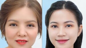 Cắt mí hay Treo cung mày? Tư vấn chọn phương án tối ưu cho từng cấp độ lão hóa.