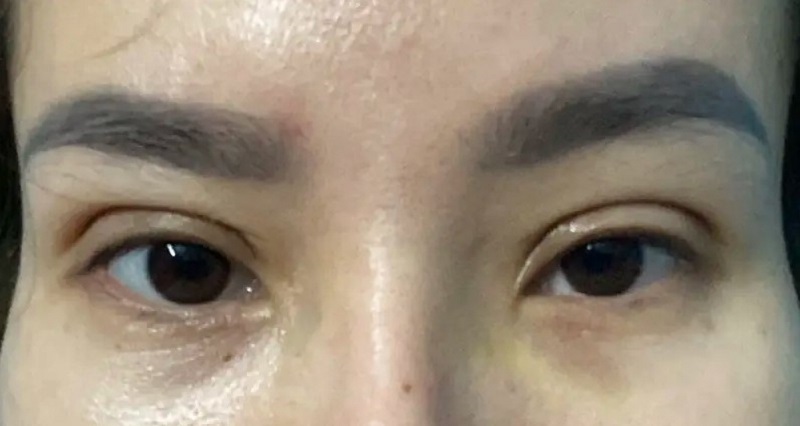 Biến chứng cắt mí tại thẩm mỹ viện chui