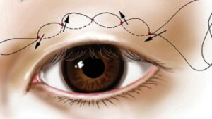 So sánh Cắt mí và Bấm mí: Phương pháp nào trẻ hóa đôi mắt bền vững nhất?