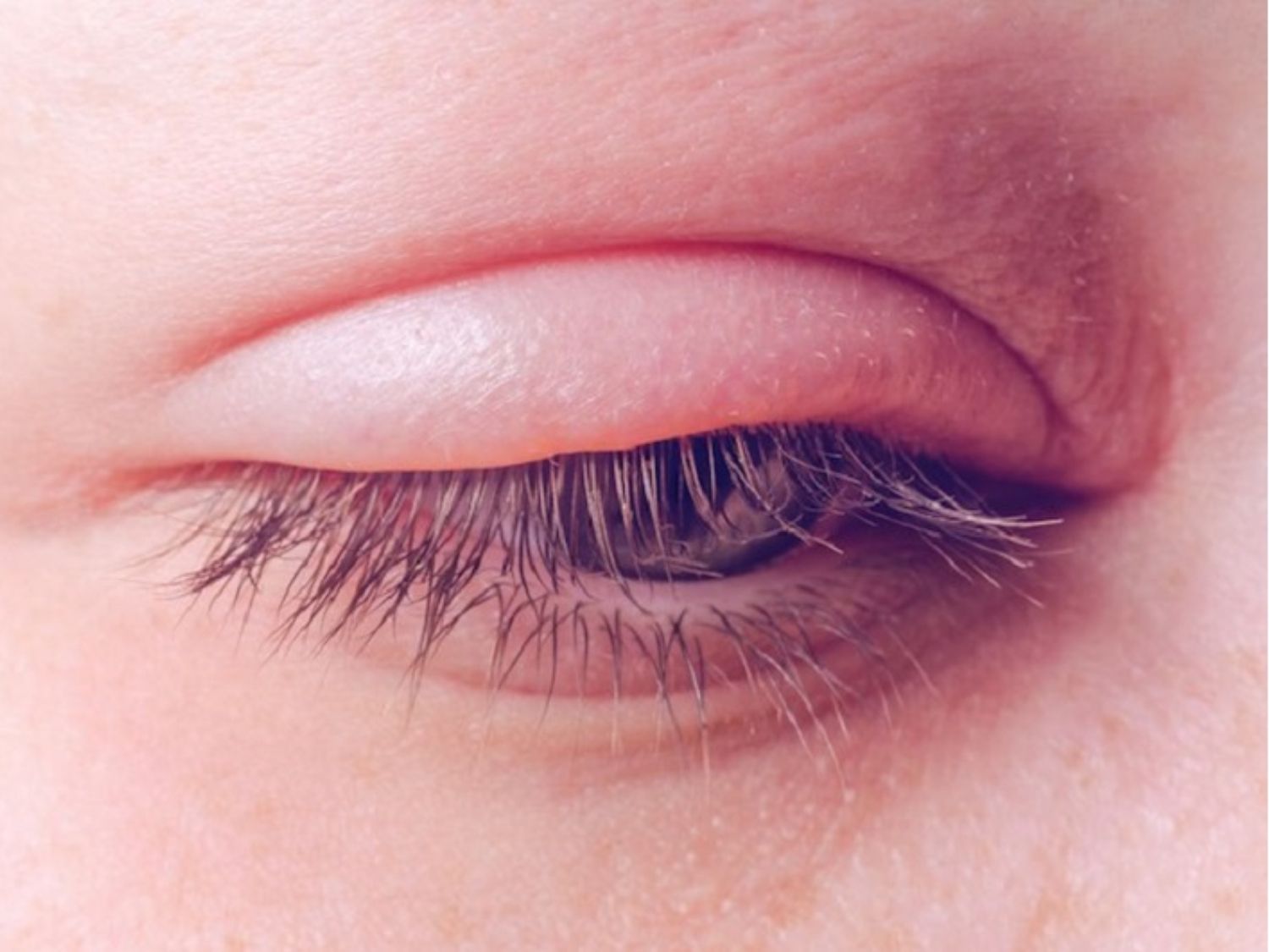 mắt sưng và đau nhiều không giảm sau khi cắt mí cần thăm khám sớm để khắc phục nếu có biến chứng bất thường