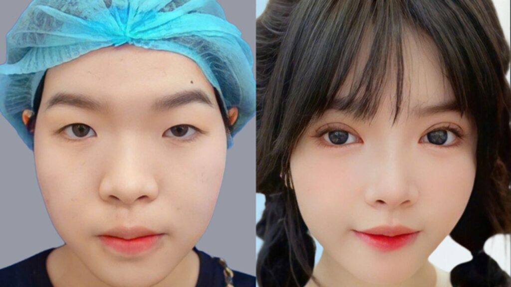 Cắt mí cho mắt một mí có nên không? 5 tiêu chuẩn để nếp mí đẹp tự nhiên như bẩm sinh