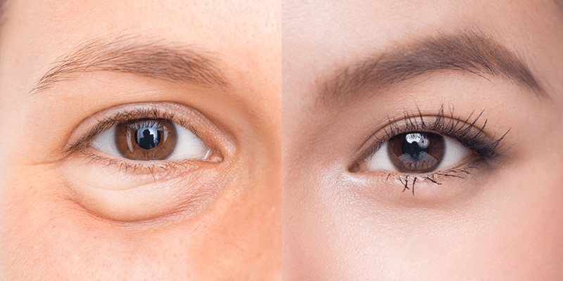 Cắt mí mắt nhiều mỡ giúp loại bỏ bọng mỡ thừa, giúp mắt 2 nếp mí rõ ràng, nhìn khuôn mặt trẻ trung thanh thoát