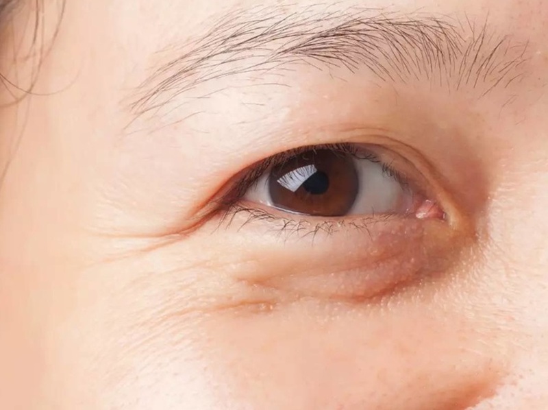 Mắt nhiều mỡ khiến vùng mắt chùng xuống, trông thiếu sức sống và già hơn tuổi