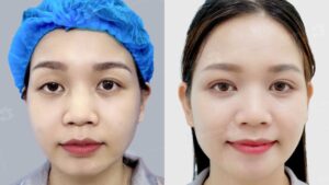 Cắt mí mắt sụp có hiệu quả không? Phân biệt sụp mí do da dư và do cơ 2026