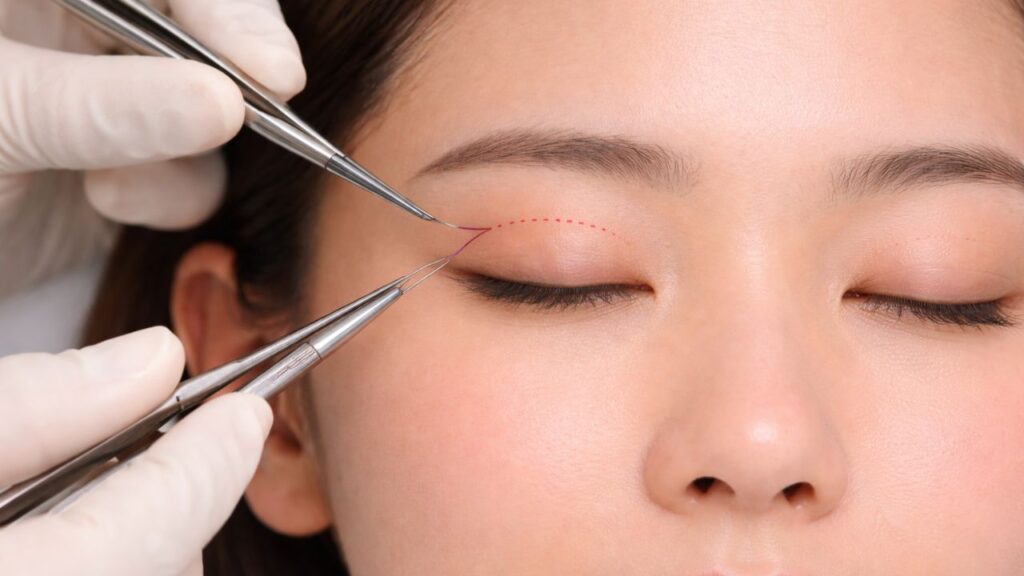 Cắt mí Mini Deep: Nếp mí vĩnh viễn, hồi phục sau 5 ngày – Những ai nên thực hiện?