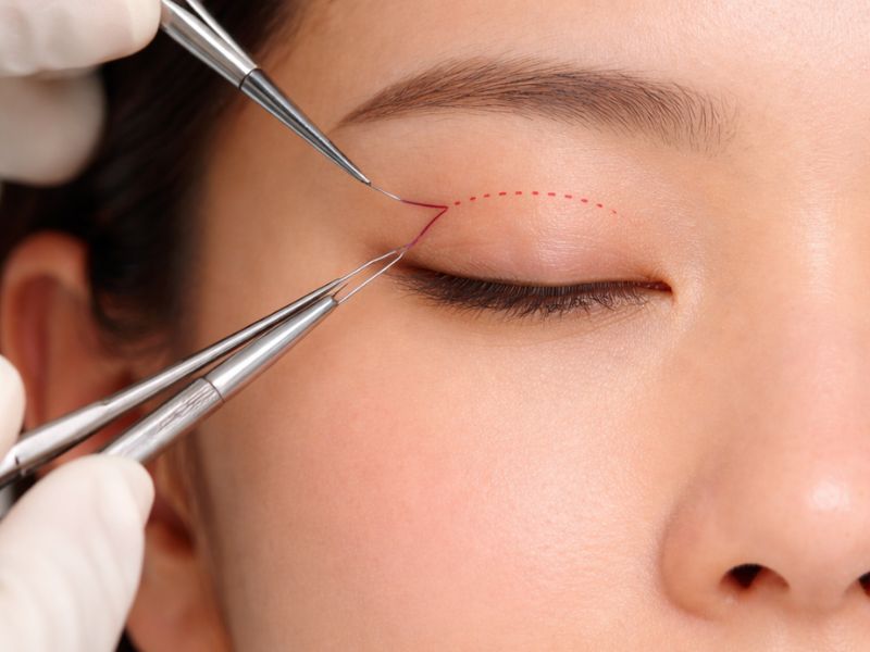 Mô phỏng kỹ thuật tạo liên kết Deep (sâu) giúp nếp mí bền vững và không bị tuột chỉ.