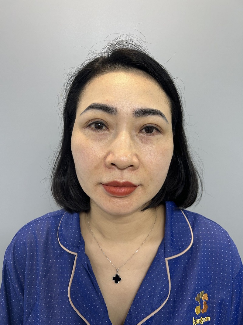 Mí mắt chị Quỳnh Mai gặp tình trạng sụp mí do lão hóa