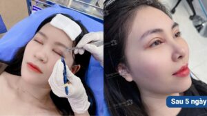 Cắt mí bị sưng bao lâu thì hết? Lộ trình giảm sưng chuẩn 2026 & Cách nhận biết dấu hiệu bất thường