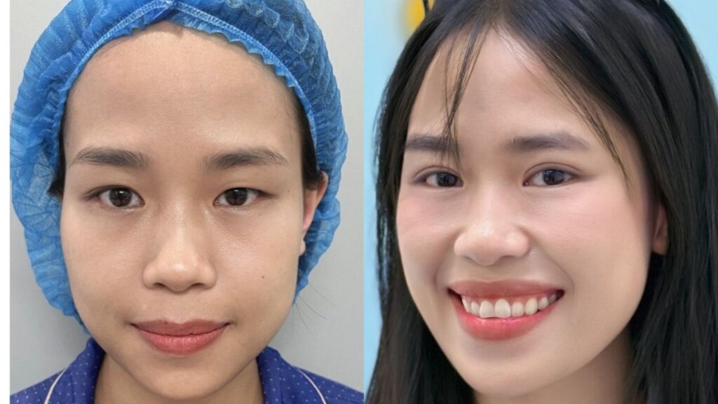 Thanh Trang “lột xác” đôi mắt 1 mí chỉ sau 7 ngày tại Kangnam Hà Nội