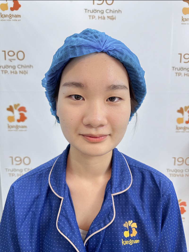 Thu Hà gặp tình trạng mí nhỏ, nhiều da dư thừa