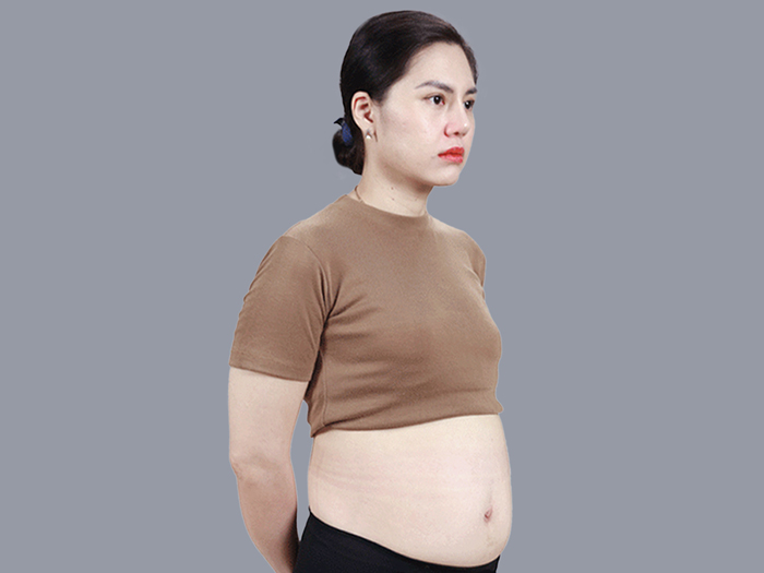 Chỉ định gây mê toàn thân cho ca đại phẫu hút mỡ tạo hình