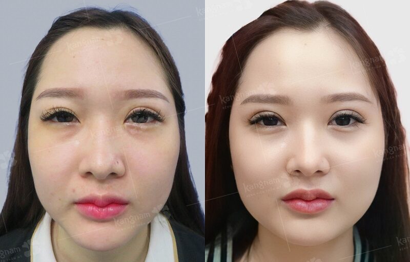 Cấu trúc mô sẹo mí mắt đã đổn định sau 6 tháng để dặm mí