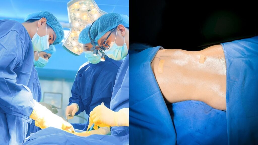 Cơ chế hút mỡ : Công nghệ hóa lỏng & Quy trình loại bỏ mỡ thừa vĩnh viễn