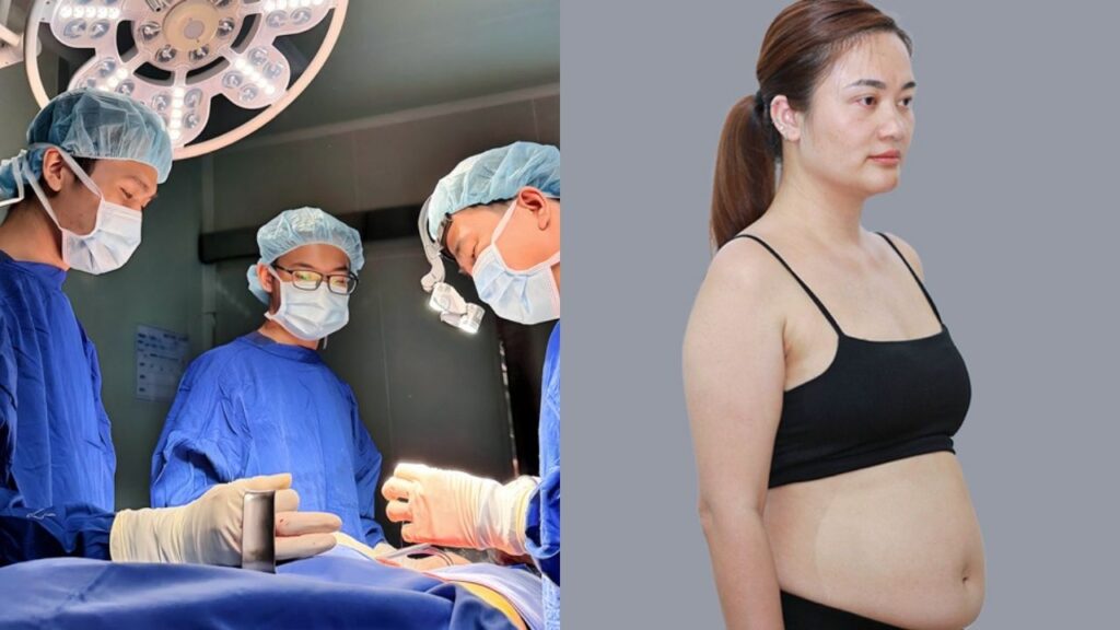 Có nên hút mỡ không? Khi nào nên và không nên