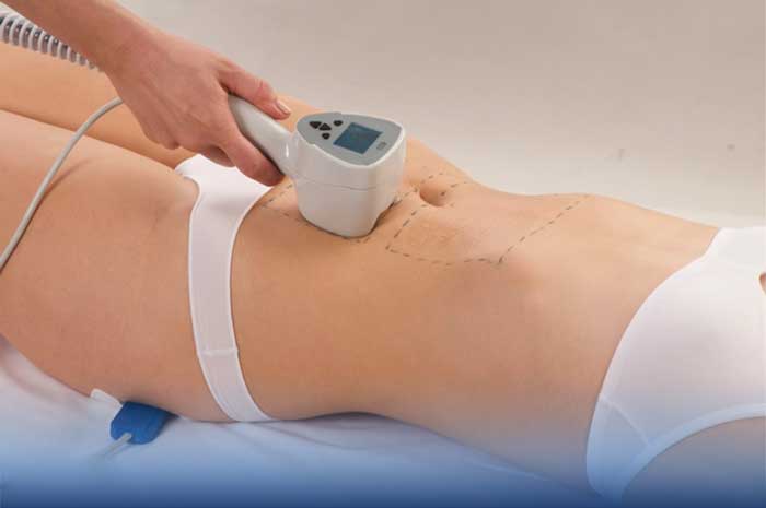 Cơ chế phá hủy tế bào mỡ bằng công nghệ giảm mỡ không phẫu thuật không xâm lấn qua bề mặt da.