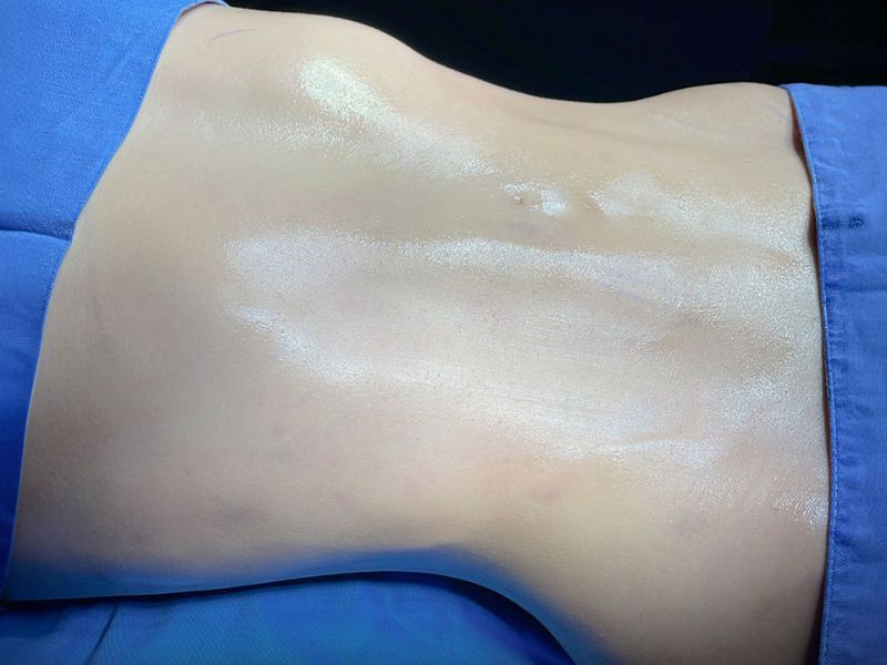 Vùng da bụng sau khi hút mỡ