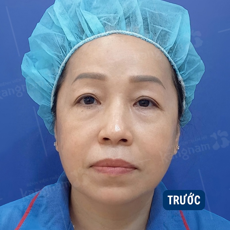 Tình trạng sụp mí nhiều mỡ thừa, da dư ở người lớn tuổi