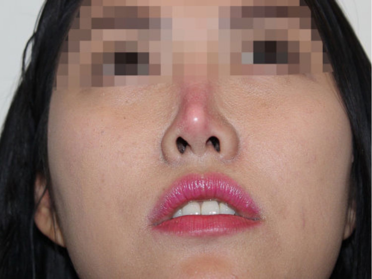 khách hàng bị biến chứng sau nâng mũi giá rẻ, khi chỉnh sửa lại tốn kém và khó khăn hơn