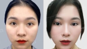 Dặm lại mí mắt: Khi nào là thời điểm Vàng và Quy trình hiệu chỉnh an toàn 2026