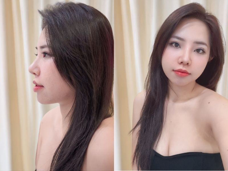 Sau 10 ngày, mũi của Hằng đã ổn định và dần tự nhiên hơn