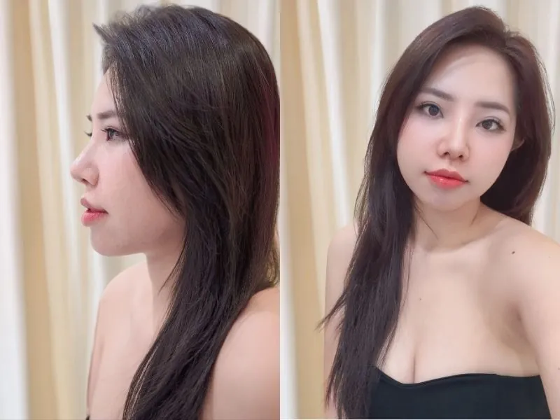 Khách hàng Thanh Hằng sau khi nâng mũi tại Bệnh viện Thẩm mỹ Kangnam Sài Gòn